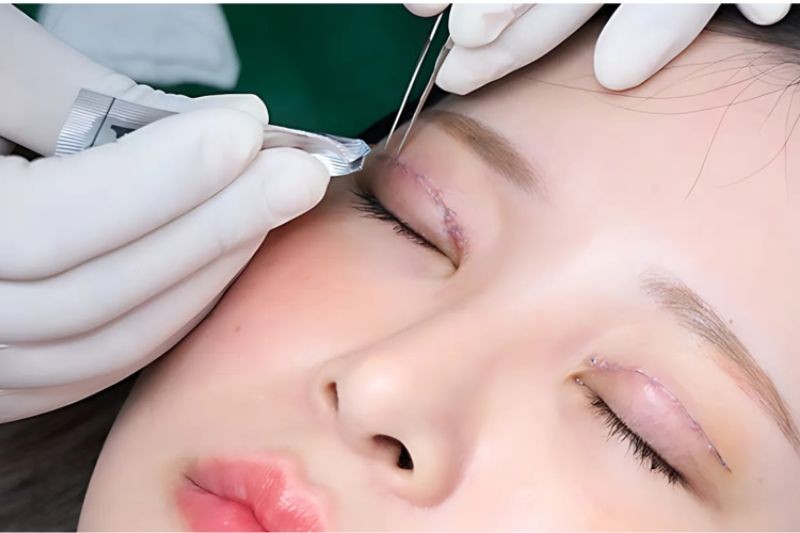 Bác sĩ đang thực hiện kỹ thuật nhấn mí cho khách hàng